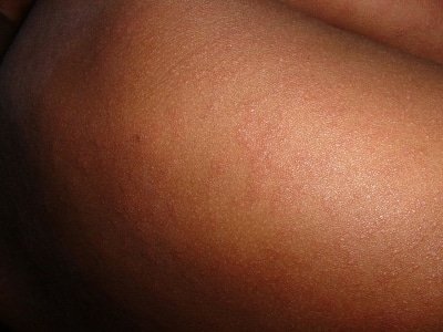 Sri Lanka Maldives Eliminate Measles Rubella In Se Asia Who
